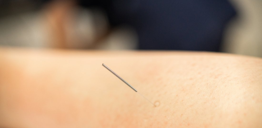 Acupuncture
